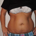 front view of tummy before TT