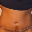 one week after TT i still have a lot of swelling