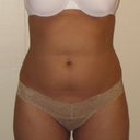 Pre-op after wt gain :(
