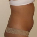 Pre-op after wt gain :(  Ughhh - pot belly