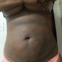 Four Weeks After Smart Lipo.