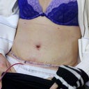 Post op Day 1, first follow-up visit. Everything is looking fine, the BB is a little bloody.