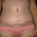 One month post-op