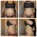 Difference 12 hours can make in swelling from night to morning.