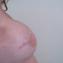 8 WEEKS AFTER SURGERY SIDE VIEW