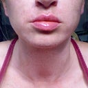 After - top lip injected with Restylane