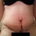 10 days post op 1 drain removed