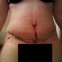 10 days post op 1 drain removed