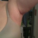 Took these a few hours after treatment #2. As you can see, the swelling was worse than the 1st time.