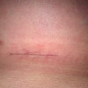 my incision at 3 weeks