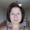 One month after ulthera