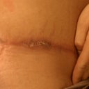 9wks & 4 days post op this is my right hip where a stitch was causing me to get alittle infection cause it wouldn't come out.....this pic look good campared to how my hip was looking