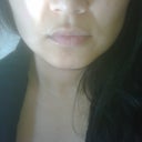 Before Teosyal - lower & upper