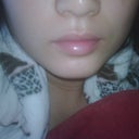 After Teosyal - lower