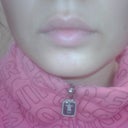 After Teosyal - upper