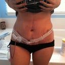 Two days post surgery.  Pretty swollen and bruised up, but looks good so far!