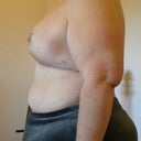 Day 13 Left breast side view