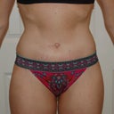 22 days, I am NOT saying  "oh look I am skinny", but I do swear I am not sucking in, I still have a lot of bloating and right now my ribs are just sticking out a bit...its strange, but looking better!