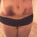 PO 15 incision