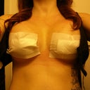 This photo is two day post op