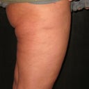 Venus Freeze Of The Thighs 