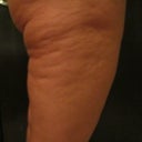 Venus Freeze Of The Thighs 