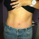9 weeks 2 days.. belly button is still healing.  Glad stretch marks don't look so bad anymore!