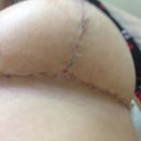 23 days post op