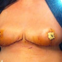 Day 6 post op.