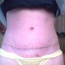 1 month post op. My scar is more wiggly than others I've seen, but not complaining.