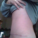 Left side. Swelling is minimal. Scar is beginning to fade. No dog ears at all.