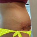 Ahhhh so lovely!!!!! six days post op