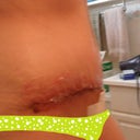 six days post op