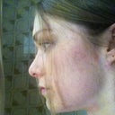 Nose two weeks. Again ezcema on my face too :(