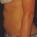 Side view pre-prodecure 5/30