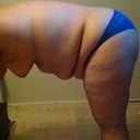 I have lost 80 lbs, I need all this extra skin off!