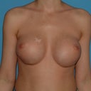 Breast implant revision surgery #1 with original Dr. went from 32a/b to 34b saline...