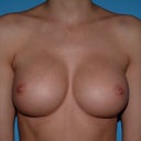 Final revision surgery with Dr. E, went from 34b to 34 full C/ 34 small D silicone..
