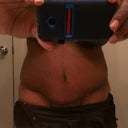 Two days shy of 7 weeks post op. I still have some uneven swelling around the incision and sides, but it's shaping up nicely. Compare post op photo around the pubic area. 
The spitting stitches are closing up as well. Once the swelling is gone I think the suture line will be tight in those areas so there shouldn't be too much of a need for a scar revision.