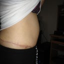 see the bulging area above belly button.
