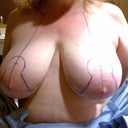Before, marked for surgery. 36GG