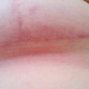 Anchor scars at 6 months post-op