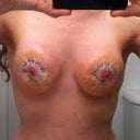 Frankenstein boobs!
