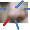 restylane was to be injected at red arrow only. Dr injected at all blue arrows