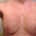 Week 3 post-op and starting to have more of a shape finally.