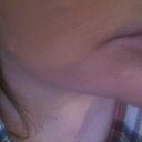 Holes that turned into lines.  The mouth area is the worst.  It is where I had fillers just 5 or 6 weeks prior to Fraxel.  I asked the nurse about the timing of this and she said, "Oh, you're almost 6 weeks out.  You'll be fine."  NO SO!  Fraxel melts the fillers and causes even more damage.  My skin is horrible all over my face but it is especially bad around the mouth that looks like I'm about 80.  Devastating!