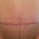 12 Weeks PO - close up of incision