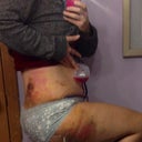 5-days post-op bruises from Lipo on outer thigh and stomach for contour.