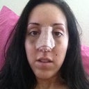 Day three after surgery