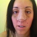 Day four after surgery